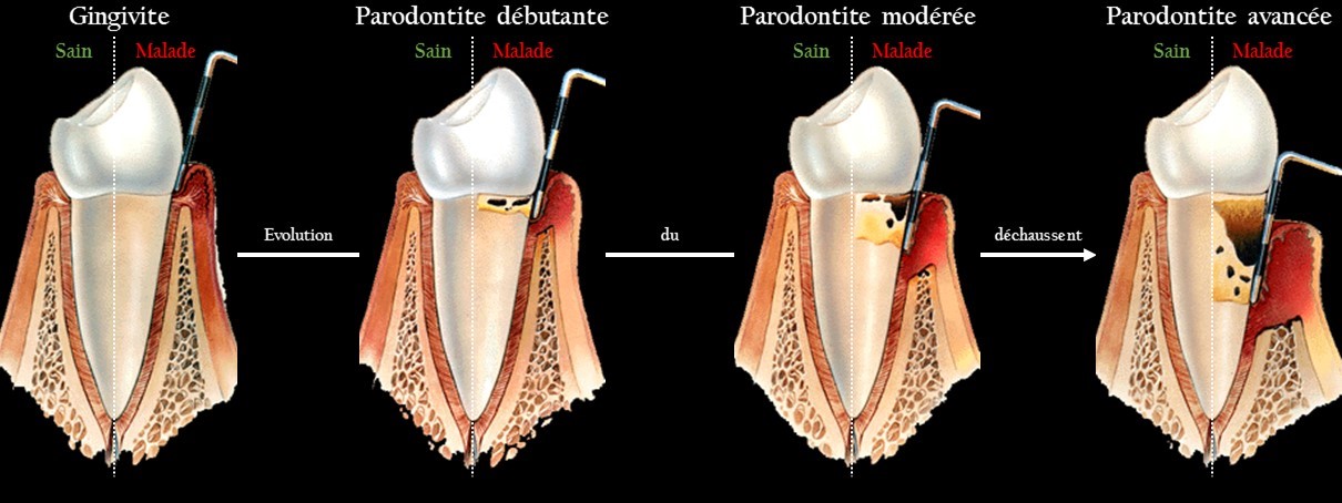 Etapes de la maladie parodontale - Cabinet Dentaire Les Dauphins - Baie-Mahault - Guadeloupe
